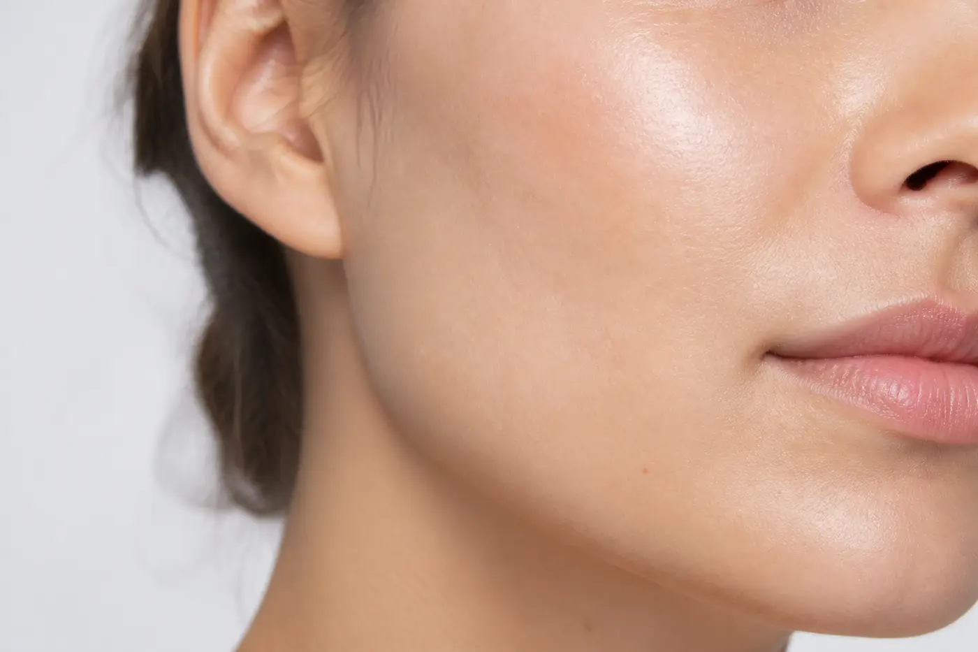 Cheek with mixed acne scar shapes shown during a dermatology assessment