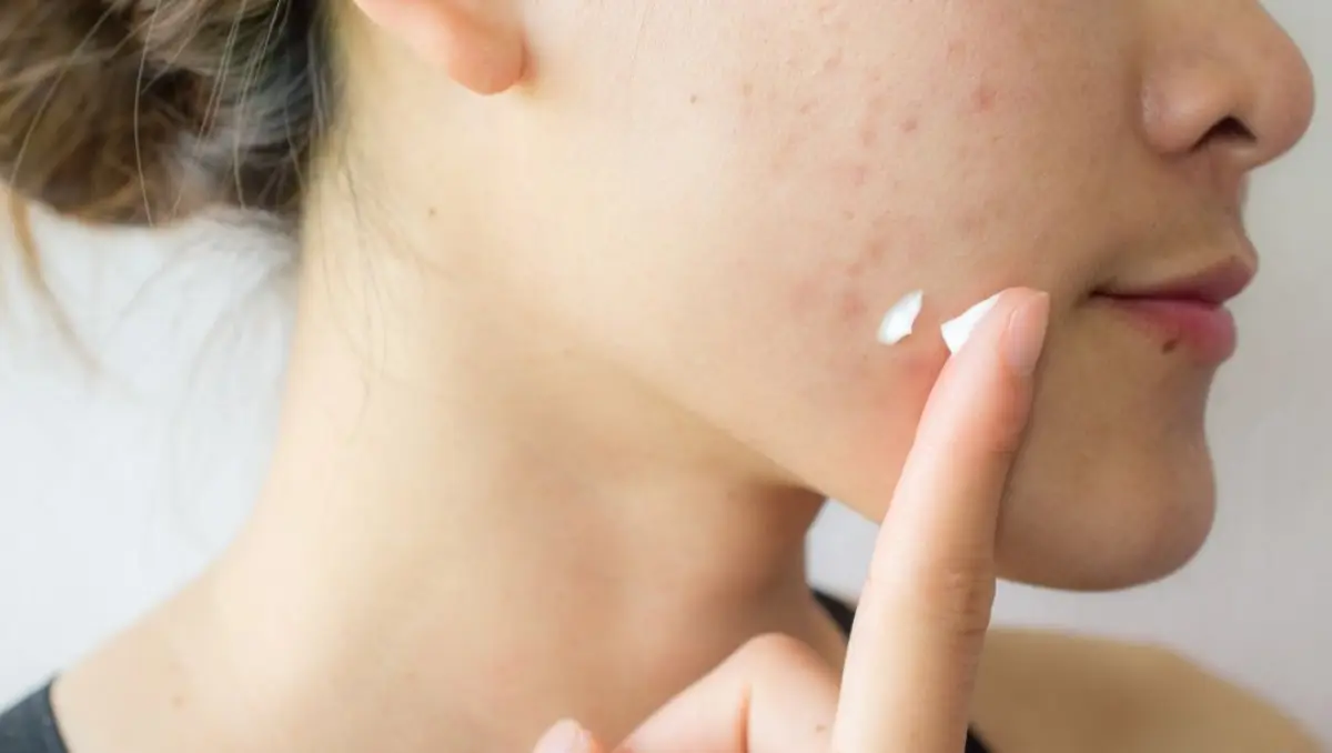 Close view of adult skin with scattered acne along the jaw and cheeks