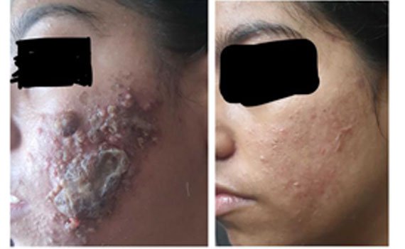 Before and after photograph published on the AB Skin Clinic gallery.