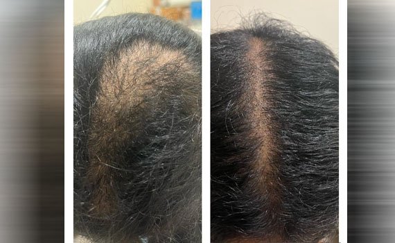 Second before and after photograph published on the AB Skin Clinic gallery.