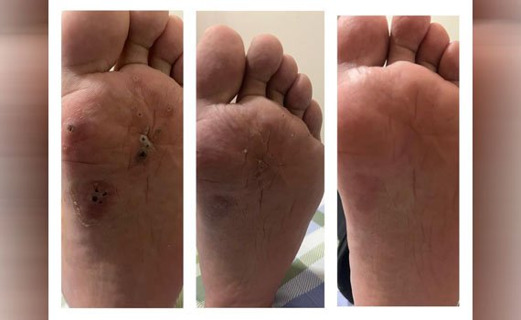 Third before and after photograph published on the AB Skin Clinic gallery.