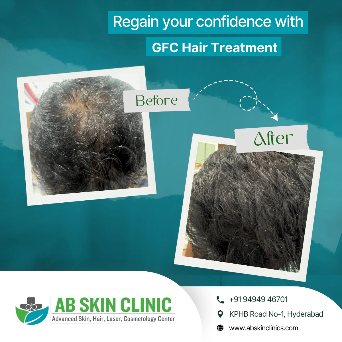 Clinic photograph published with the caption GFC hair treatment.