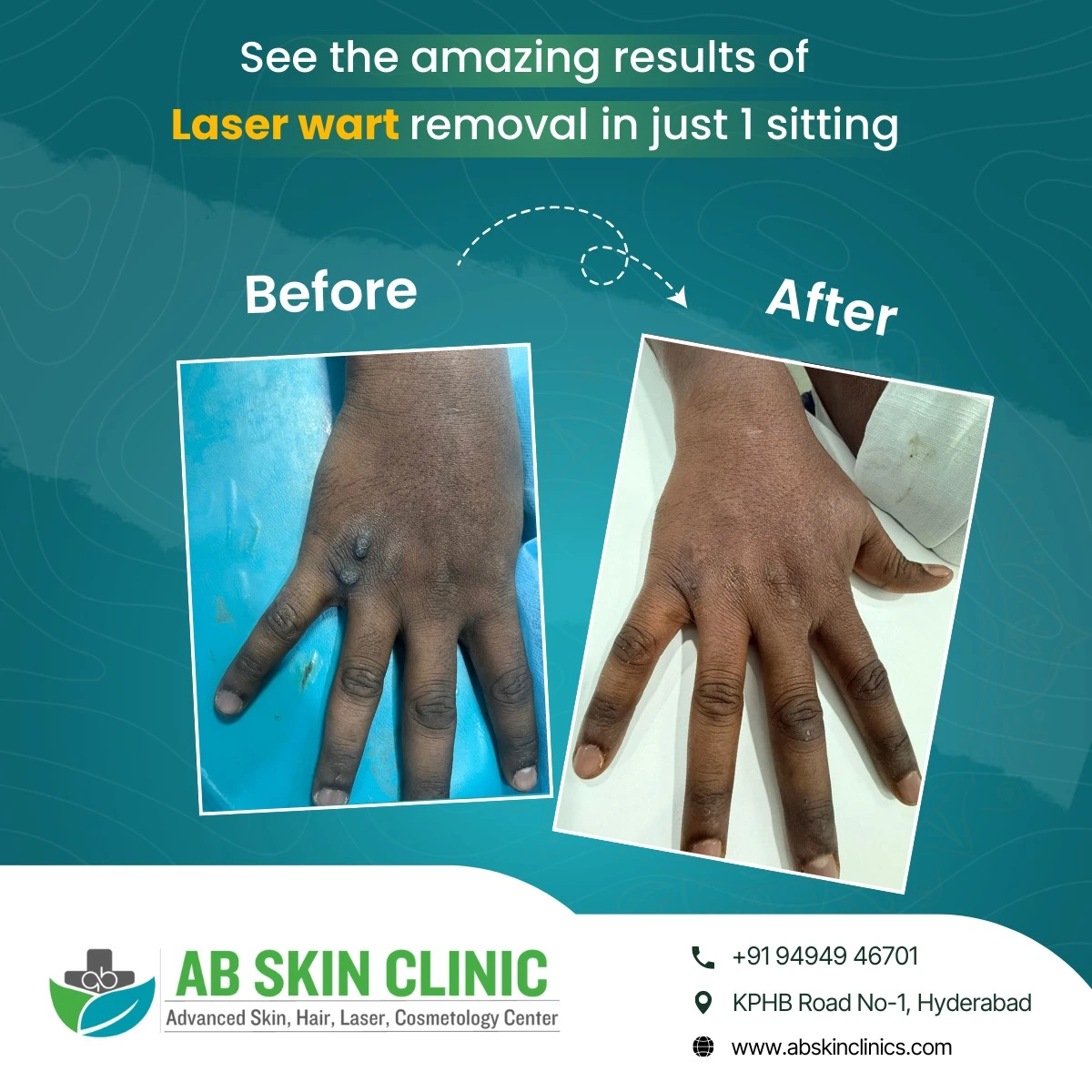 Clinic photograph published with the caption laser wart removal.