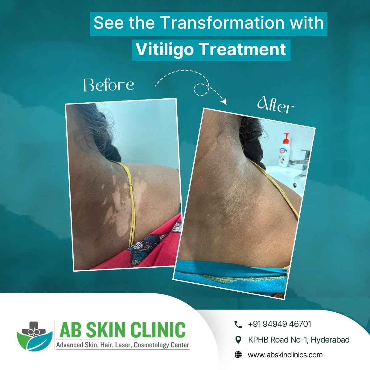 Clinic photograph published with the caption vitiligo treatment.