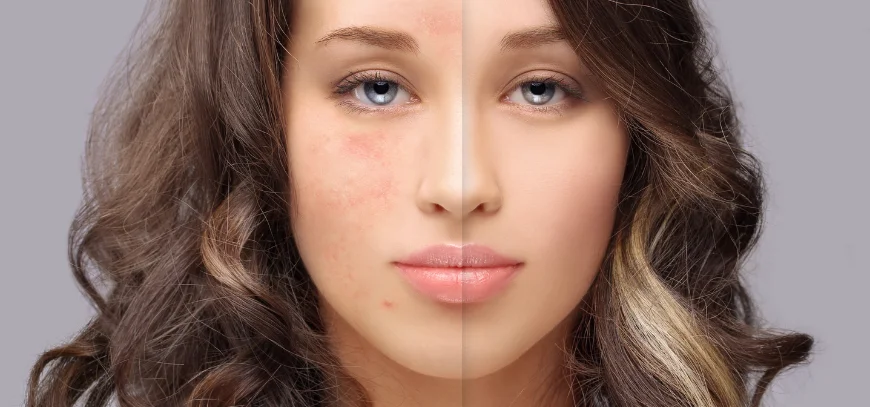 Close view of facial skin texture during an acne scar consultation