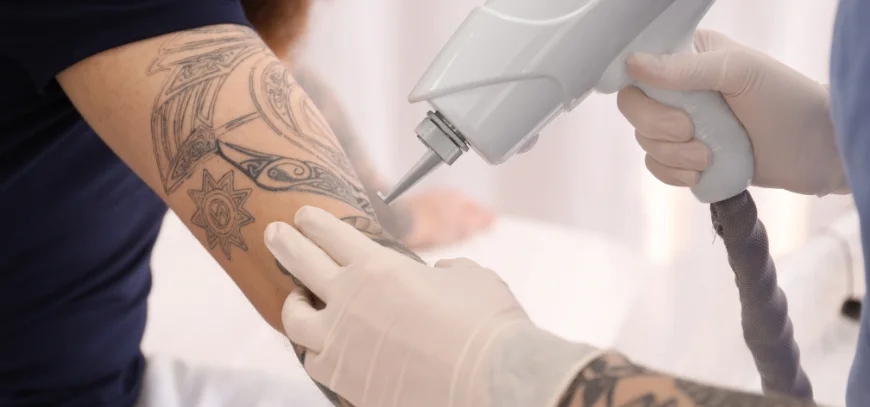 Laser tattoo removal consultation at AB Skin Clinic in Hyderabad